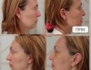 photo gallery before   after
