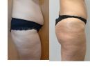 apotelesma mini koilioplastikes kai mataphora lipous stous gloutous1