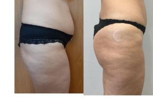 apotelesma mini koilioplastikes kai mataphora lipous stous gloutous1