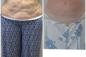 diorthose chalaroses koilias me laser minimal invasive