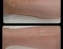 therapeia dyschromion me laser